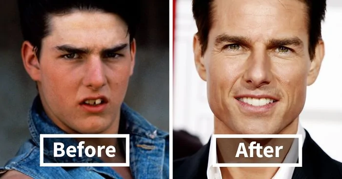 Ford Bronco Before and After pictures: Ordering vs. Getting your Bronco!! (FUN Thread!!) dental-braces-before-after-fb7__700-png